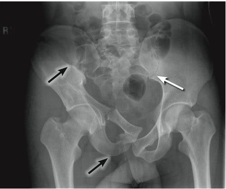 Ask a Pro: Pelvic Instability and Emergency Treatment